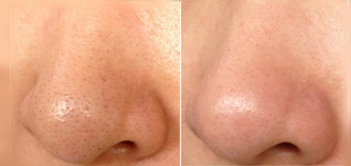 point noir Avant et après le masque de points noir